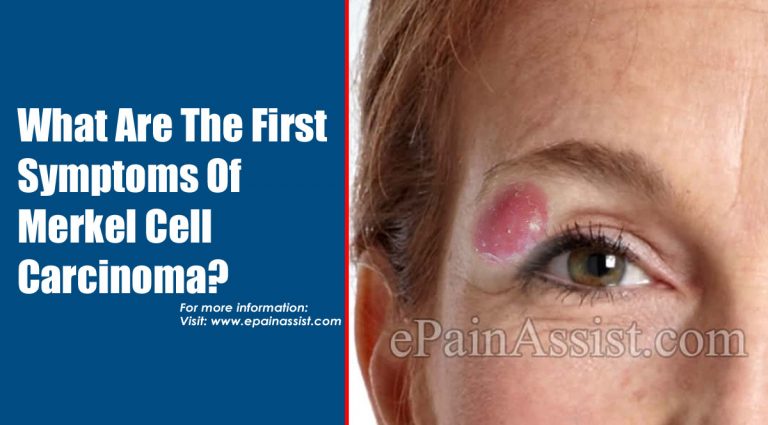 What Are The First Symptoms Of Merkel Cell Carcinoma & How Do You Test For It?
