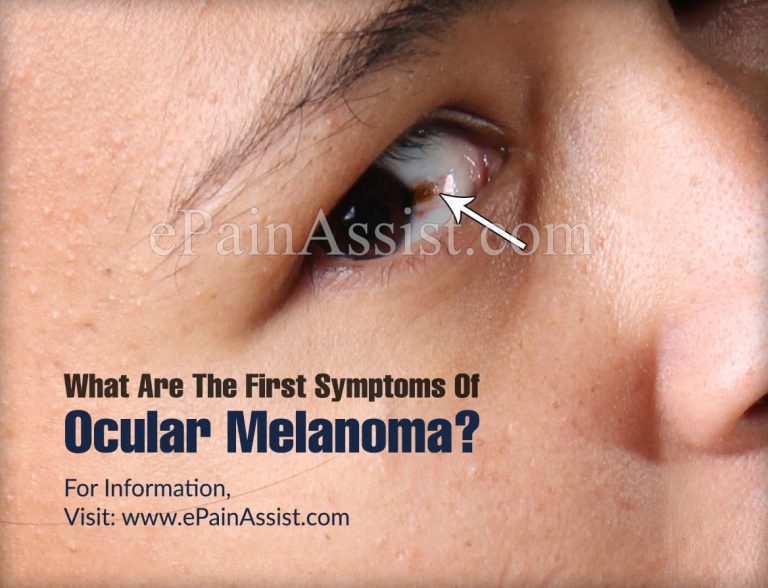 What Are The First Symptoms Of Ocular Melanoma & How Do You For It?