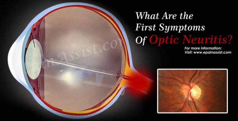 What Are The First Symptoms Of Optic Neuritis & How Do You Test For It?