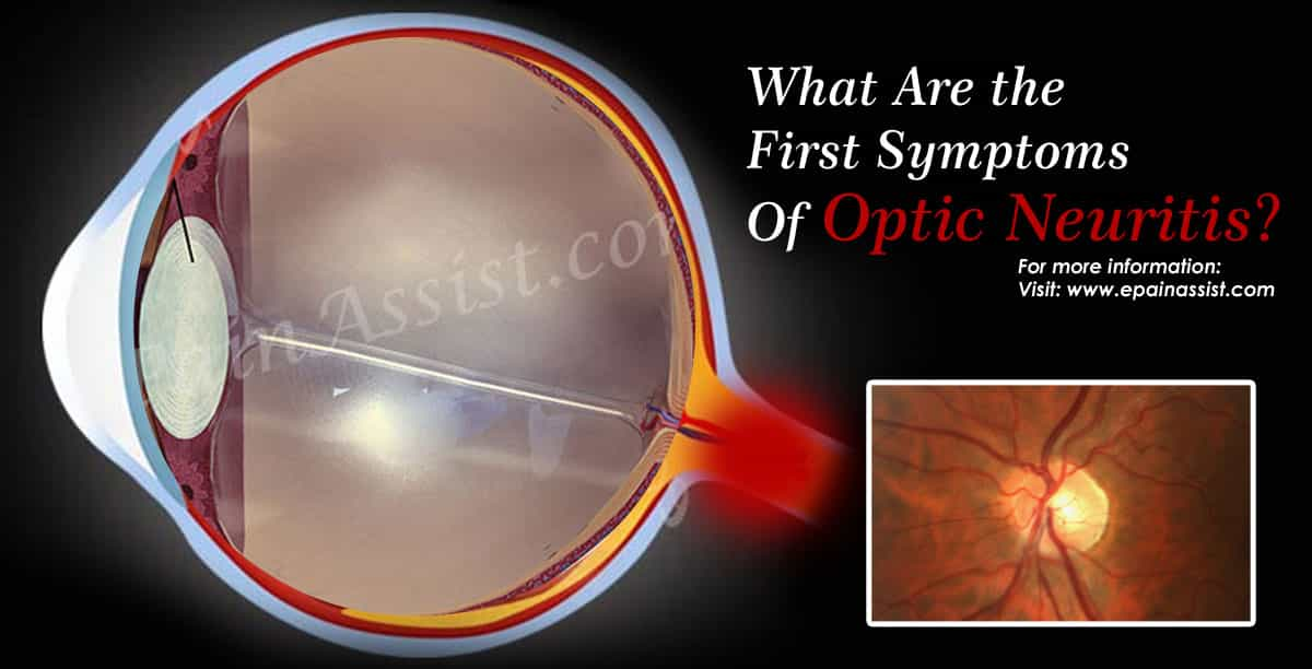 What Are the First Symptoms Of Optic Neuritis?