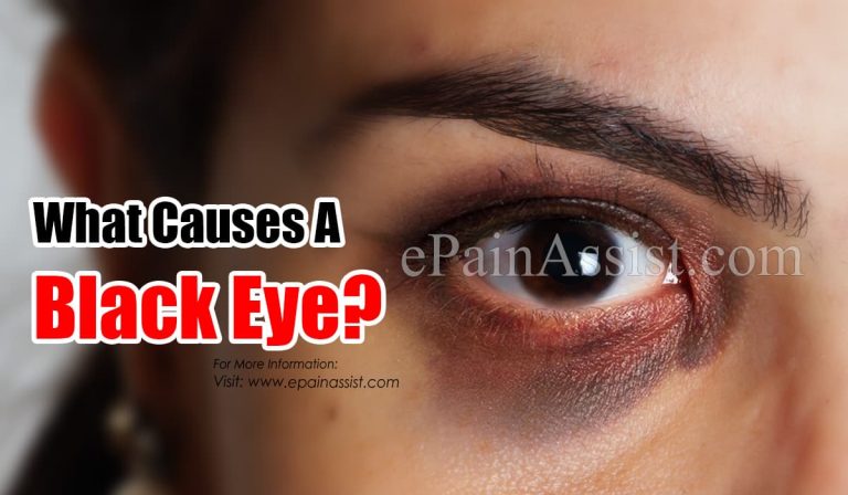 What Causes Black Eye & How Long Does It Last|Symptoms & Treatment of Black Eye