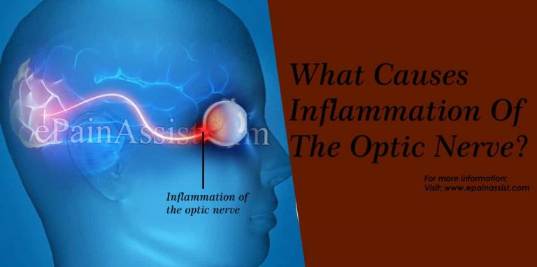 What Causes Inflammation Of The Optic Nerve?