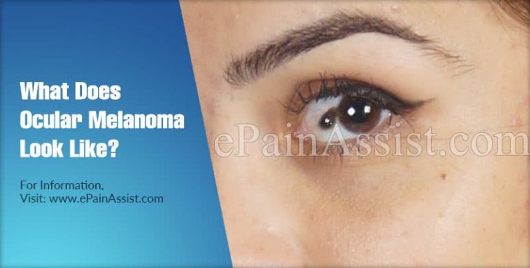 What Does Ocular Melanoma Look Like & Who Is Most Likely To Get It?