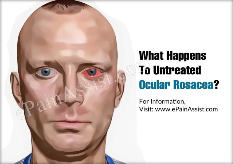 What Happens To Untreated Ocular Rosacea & When To Go To A Doctor?