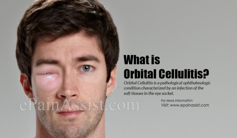 What is Orbital Cellulitis: Causes, Symptoms, Treatment, Diagnosis