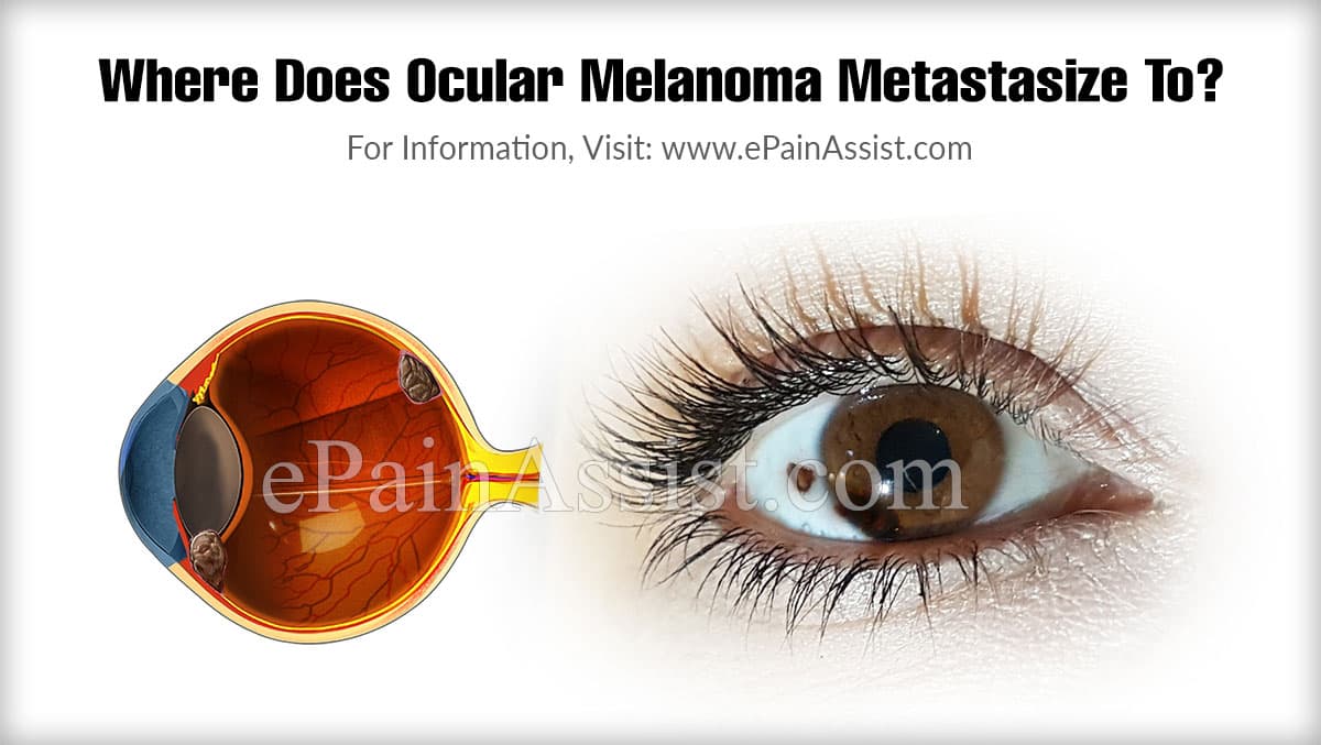 Where Does Ocular Melanoma Metastasize To?