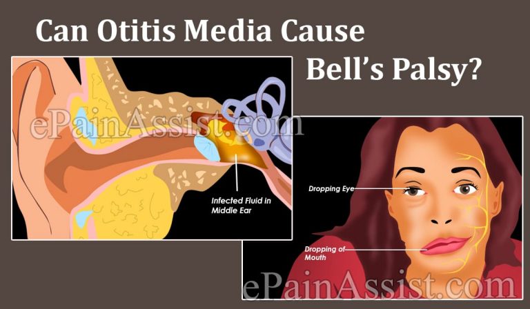 Can Otitis Media Cause Bell’s Palsy & Is It Related To Lupus?