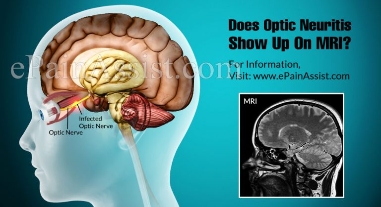 Does Optic Neuritis Show Up On MRI & Can Eye Test Detect It?