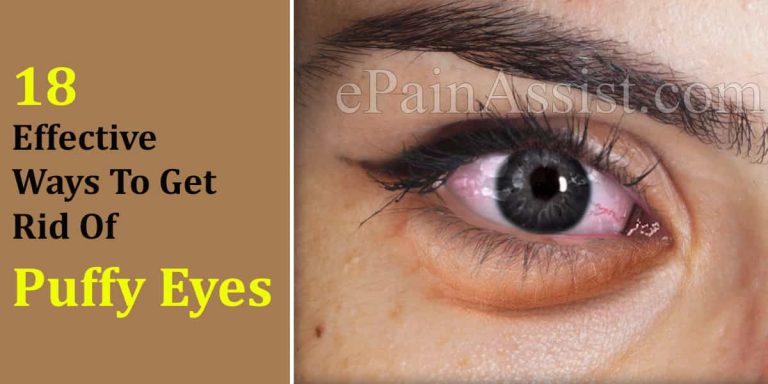 18 Effective Ways To Get Rid Of Puffy Eyes