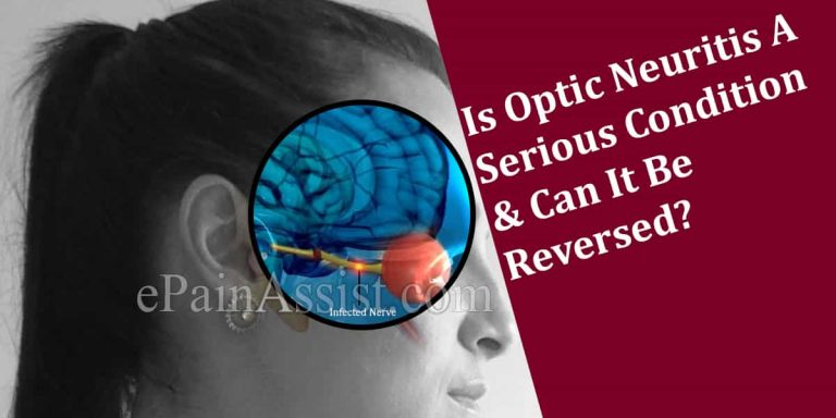 Is Optic Neuritis A Serious Condition & Can It Be Reversed?