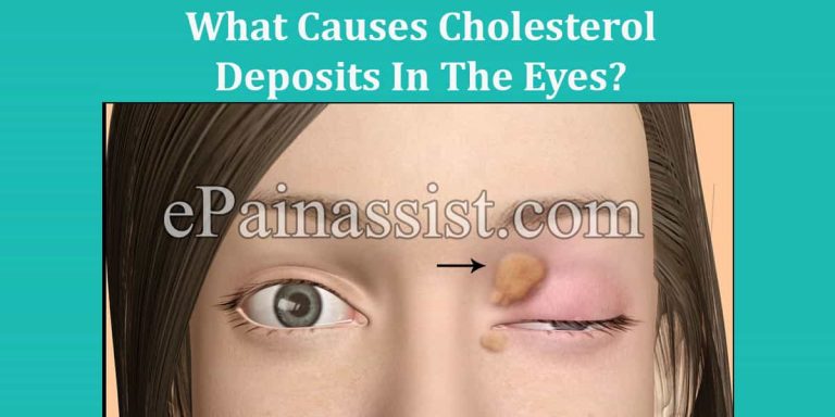 What Causes Cholesterol Deposits In The Eyes And How To Get Rid Of Them?