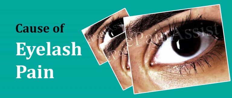 What Causes Pain In Eyelashes & How is it Treated?