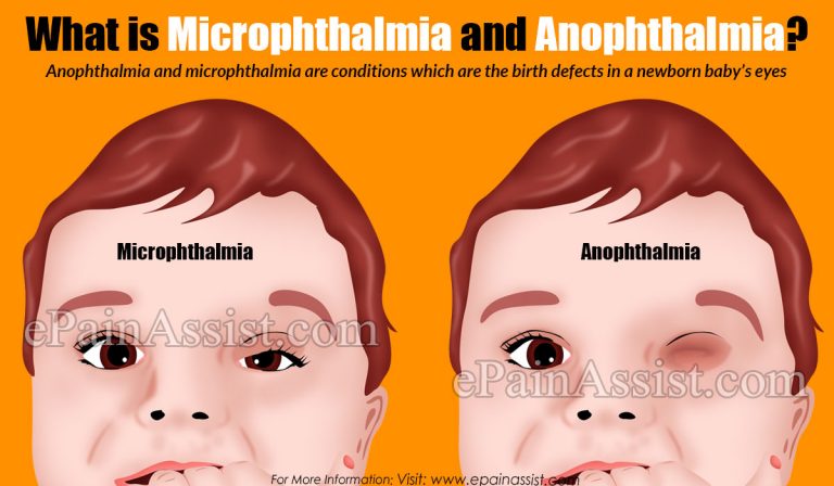 What is Microphthalmia & Anophthalmia & How is it Treated?|Causes, Risk Factors of Microphthalmia & Anophthalmia
