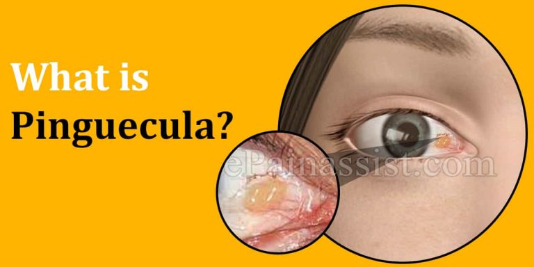 Pinguecula: Causes, Symptoms, Treatment, Prognosis