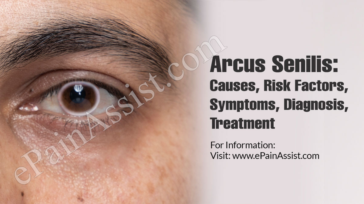 Arcus Senilis: Causes, Risk Factors, Symptoms, Diagnosis, Treatment