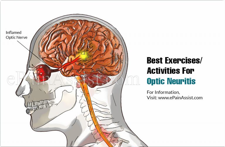 Best Exercises/Activities For Optic Neuritis