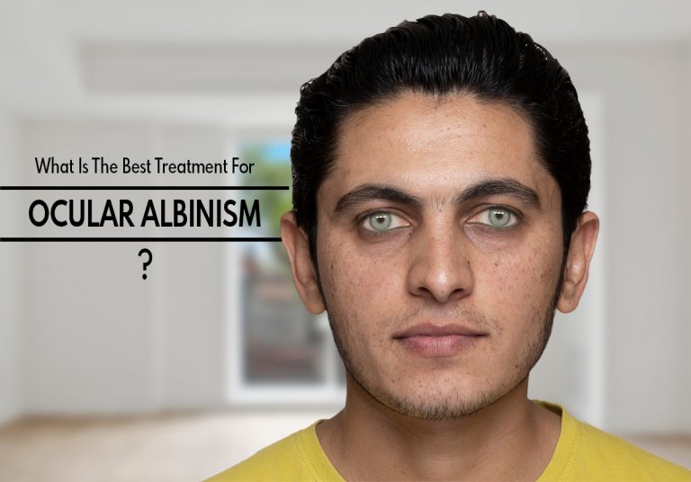 What Is The Best Treatment For Ocular Albinism?