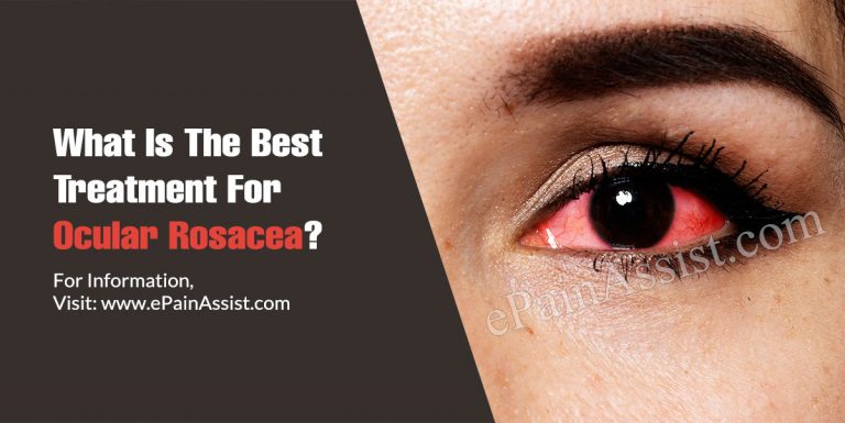 What Is The Best Treatment For Ocular Rosacea?