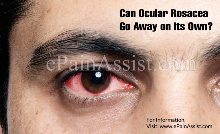 Can Ocular Rosacea Go Away on Its Own & What Are Its Natural Remedies?