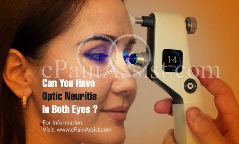 Can You Have Optic Neuritis In Both Eyes & Does It Always Lead To MS?