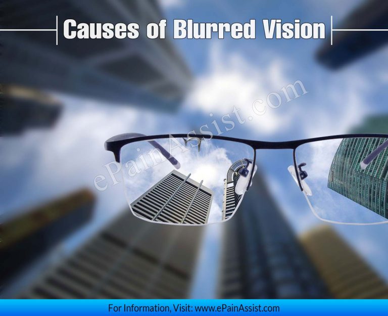 Causes of Blurred Vision