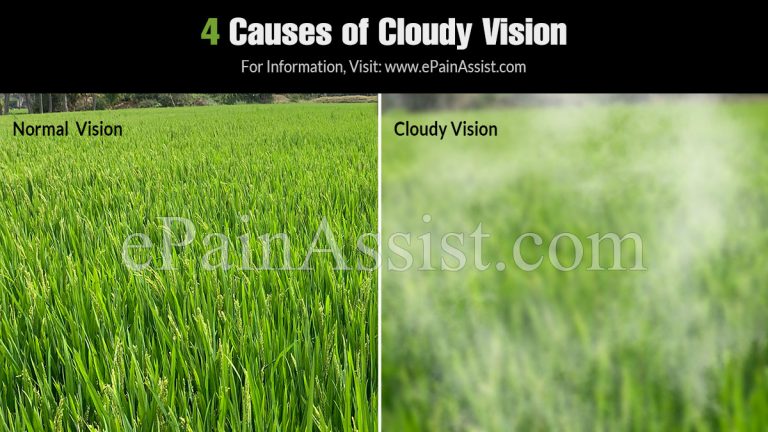4 Causes of Cloudy Vision