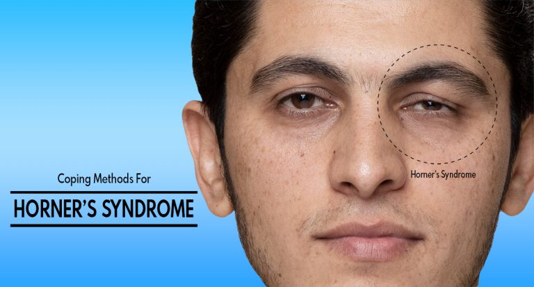 Coping Methods For Horner’s Syndrome