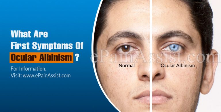 What Are The First Symptoms Of Ocular Albinism & How Do You Test For It?