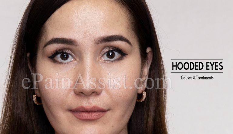 Hooded Eyes : Causes & Treatments