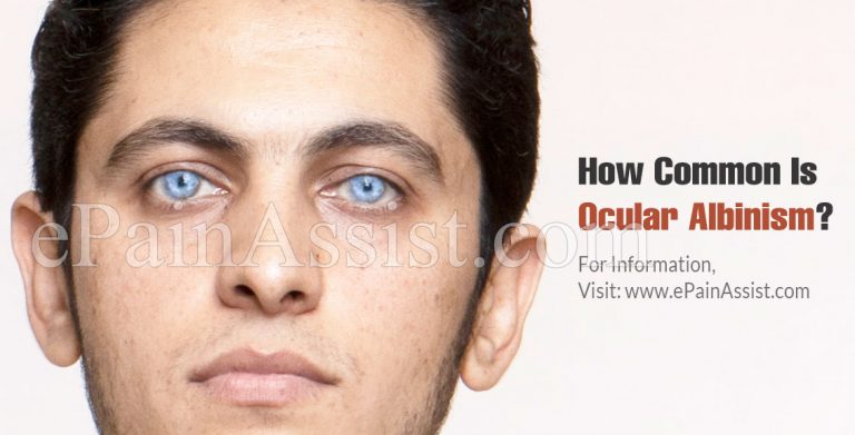 How Common Is Ocular Albinism Or Is It A Rare Disease?
