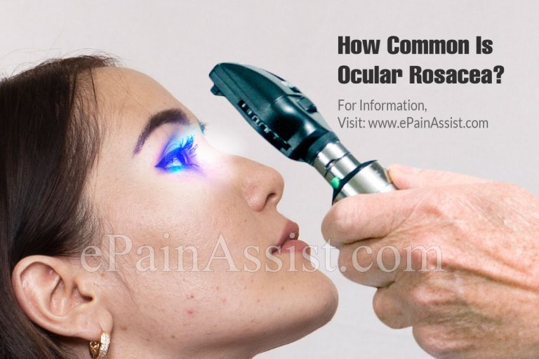 How Common Is Ocular Rosacea Or Is It A Rare Disease?
