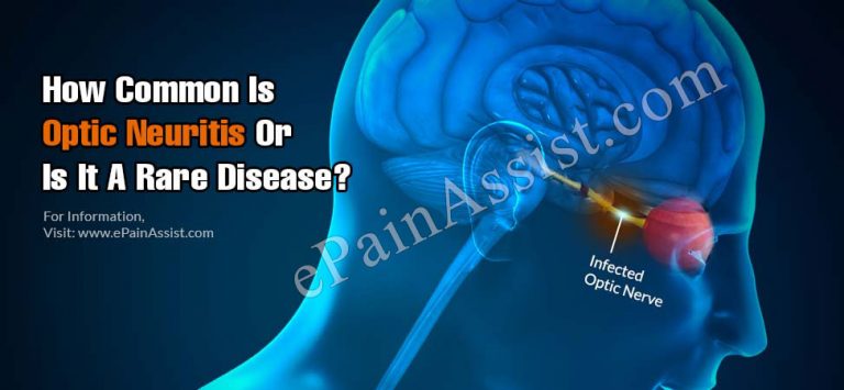 How Common Is Optic Neuritis Or Is It A Rare Disease?
