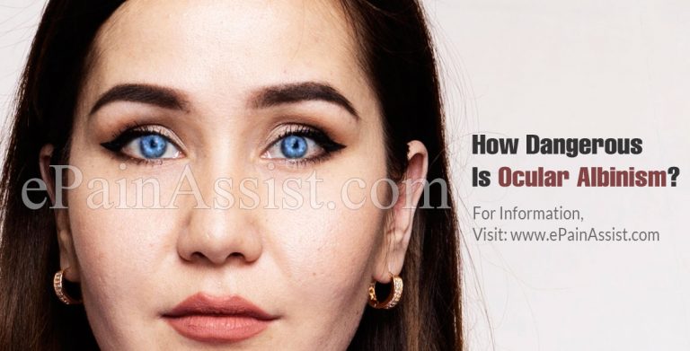 How Dangerous Is Ocular Albinism & Is It Contagious?