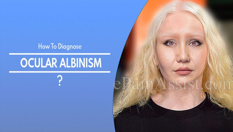 How To Diagnose Ocular Albinism & What Is The Best Medicine For It?