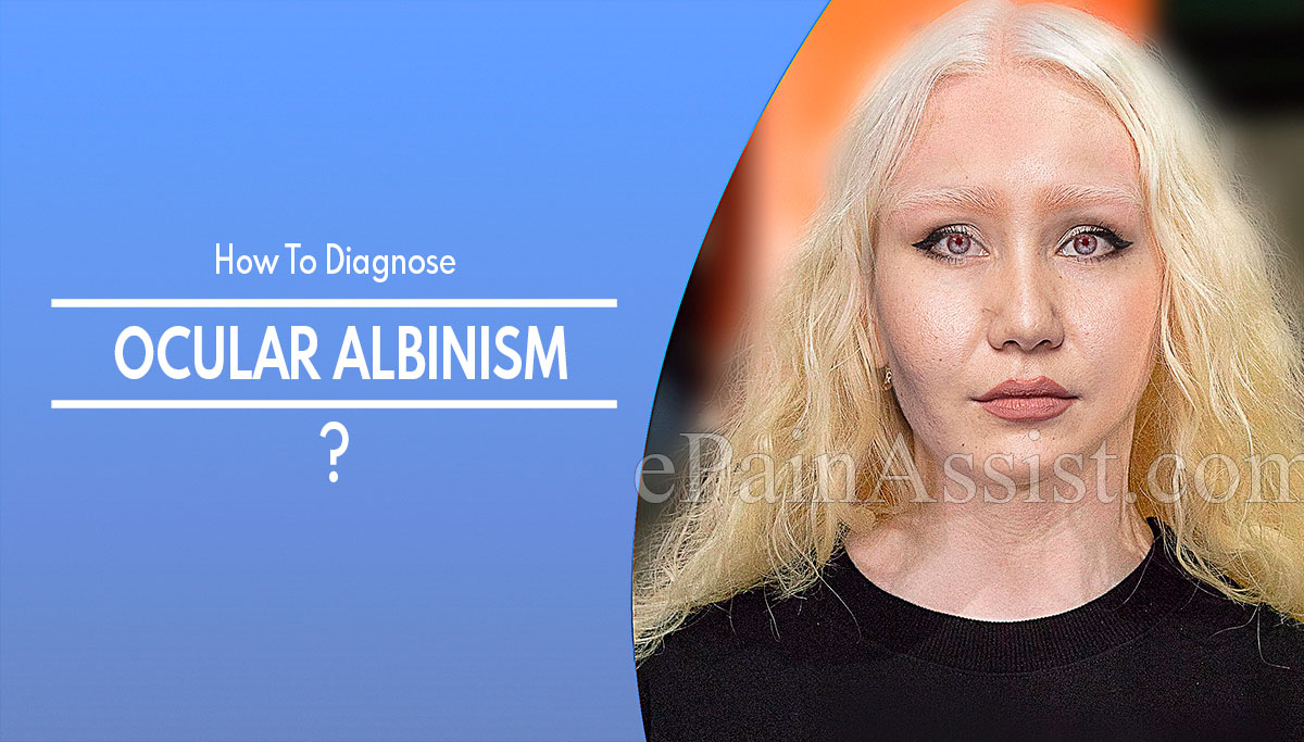 How To Diagnose Ocular Albinism?