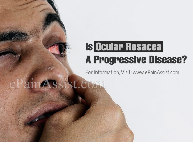 Is Ocular Rosacea A Progressive Disease & Alternative Treatment For It?