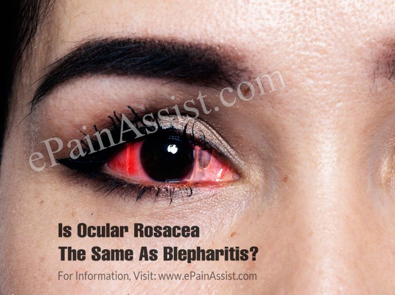 Is Ocular Rosacea The Same As Blepharitis & Does It Spread?