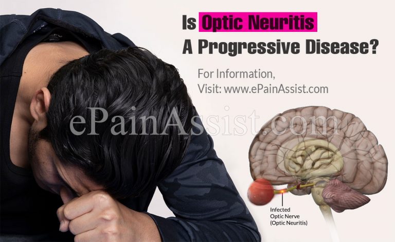 Is Optic Neuritis A Progressive Disease & Alternative Treatments For It?