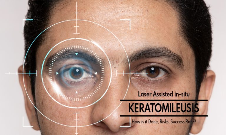Laser Assisted in-situ Keratomileusis: Who are the candidates,  How is it Done, Risks, Success Rate?