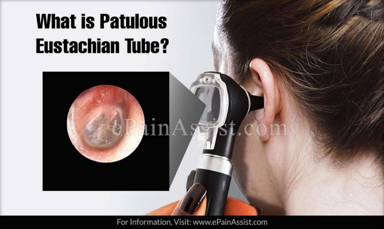 What is Patulous Eustachian Tube: Causes, Symptoms, Treatment, Diagnosis