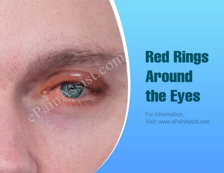 Red Rings Around the Eyes: Causes & Treatments