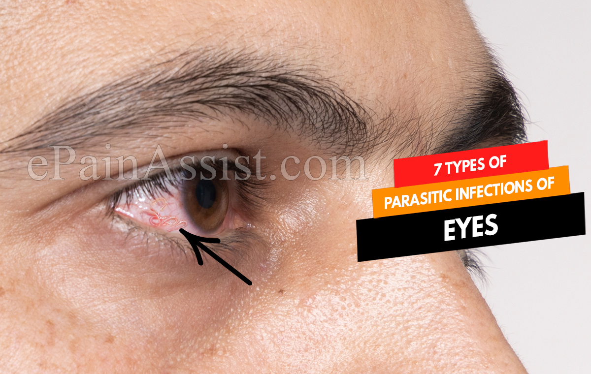 7 Types of Parasitic Infections of Eyes and their Symptoms