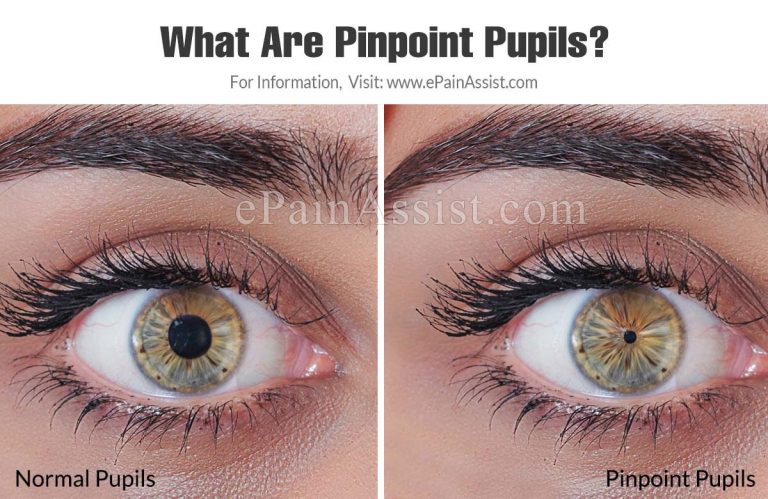 What Are Pinpoint Pupils, What Causes Them and It’s Treatment Options?