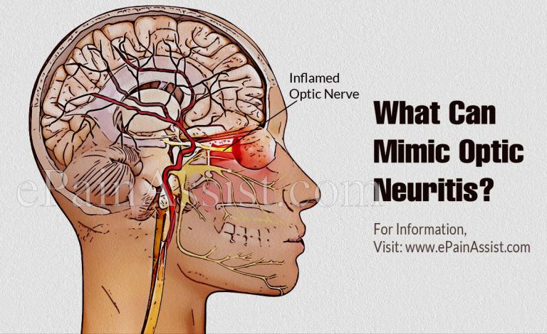 What Can Mimic Optic Neuritis & Can I Drive If I Have It?