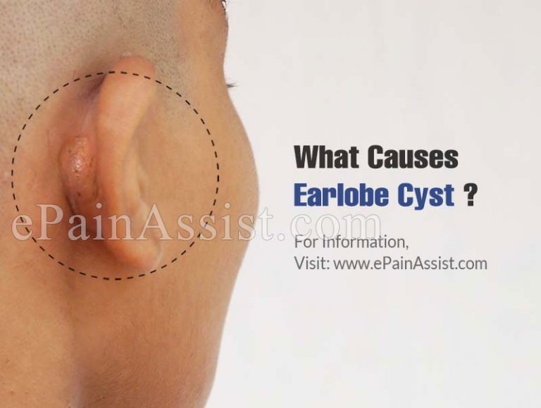 What Causes Earlobe Cyst & How To Manage It?