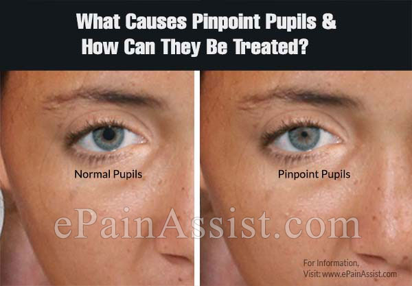 What Causes Pinpoint Pupils And How Can They Be Treated?