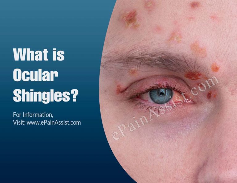 What is Ocular Shingles, Know Its Source, Symptoms, Diagnosis, Treatments
