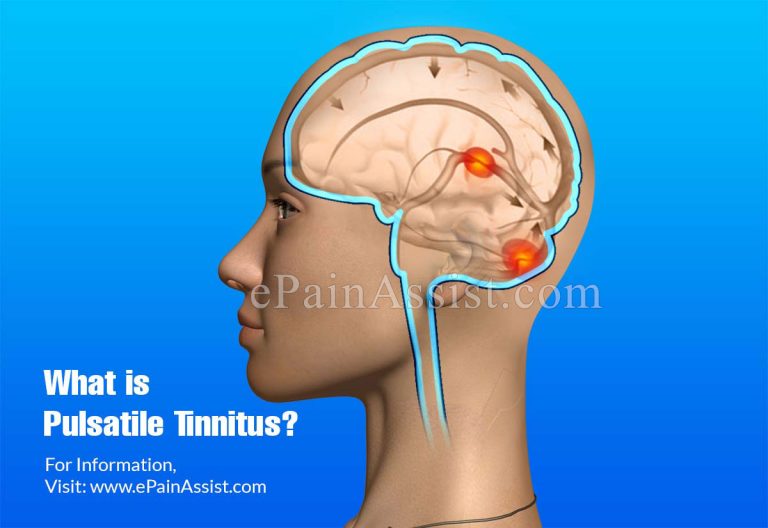 Pulsatile Tinnitus : What Can Cause Heartbeat Sound in Ears?