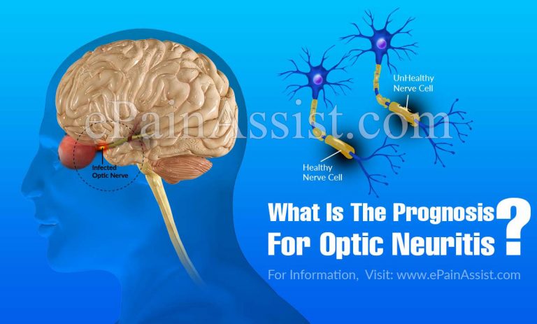 What Is The Prognosis For Optic Neuritis & Lifestyle Changes For It?