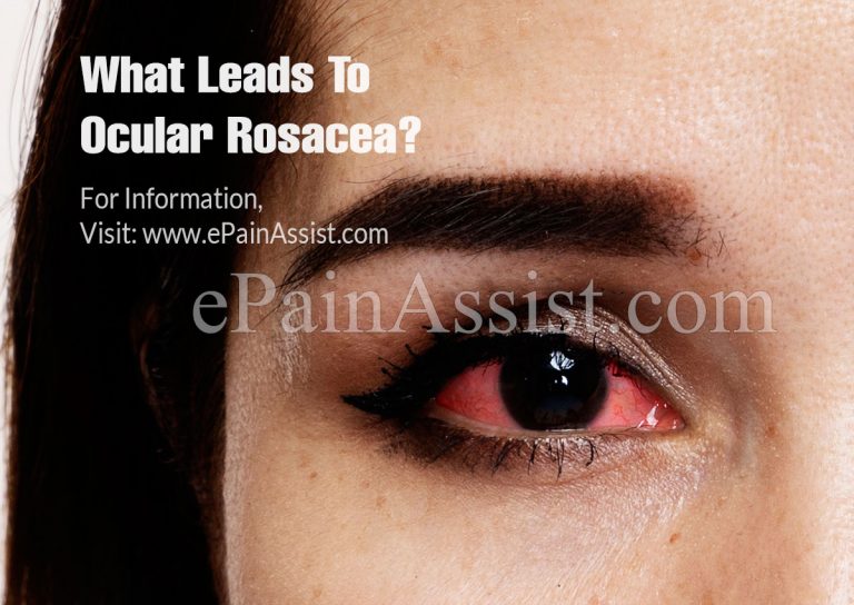 What Leads To Ocular Rosacea & Can It Be Cured?
